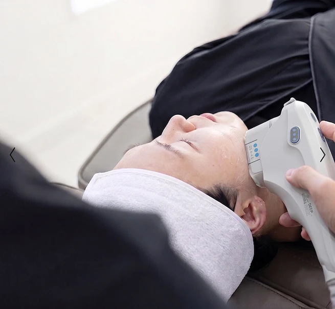 Ultherapy PRIME Treatment 4