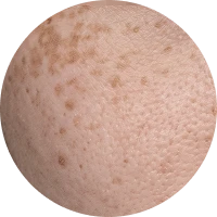 Pigmentation Image 2
