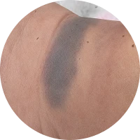 Pigmentation Image 3