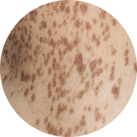 Pigmentation Image 4