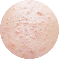 Acne Image 1