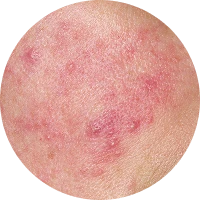 Acne Image 2
