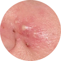 Acne Image 3