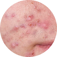 Acne Image 4