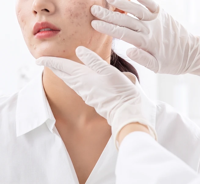 Acne Treatment 1
